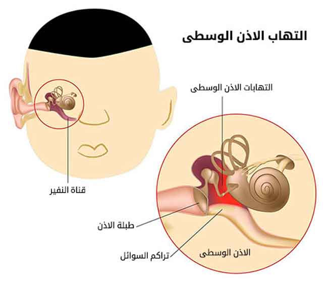 التهاب الأذن الوسطى  أعراضه وكيفية علاجه