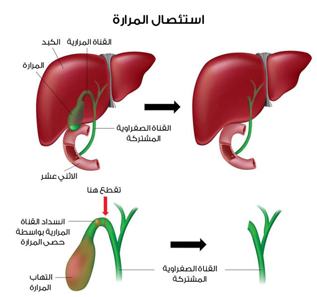 التهابات المرارة وعلاجها